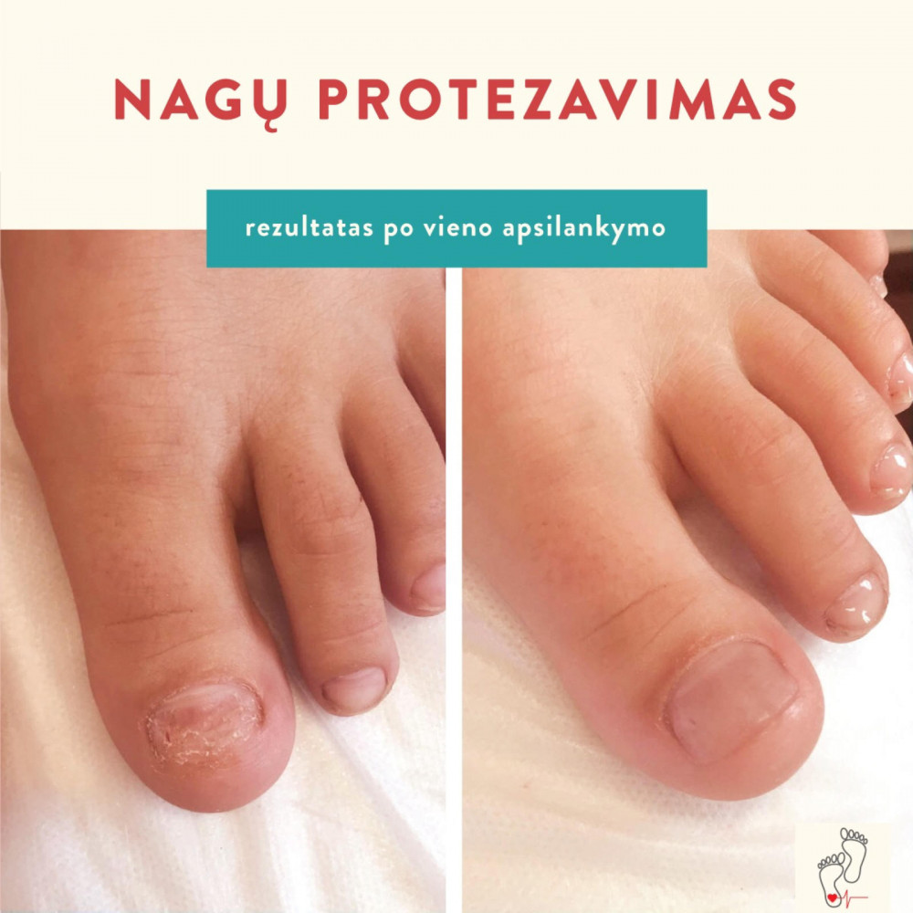 Podologija.lt pėdų priežiūra