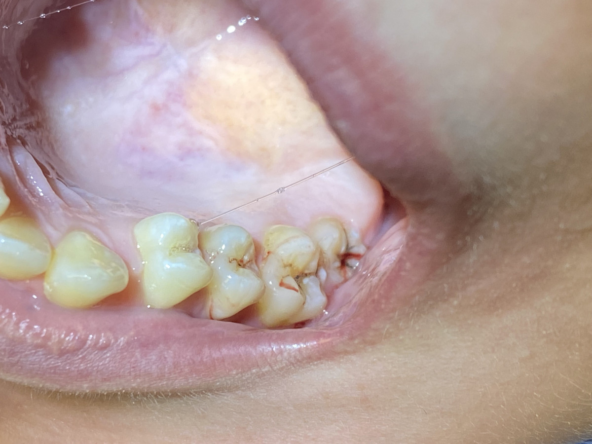 Dental V, MB