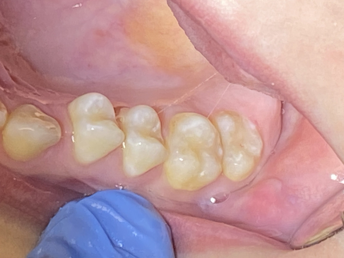 Dental V, MB