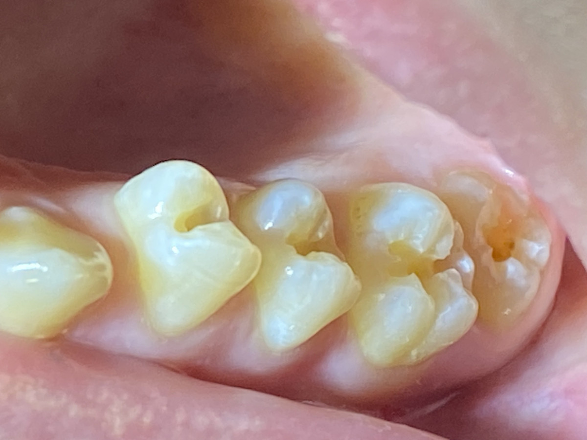 Dental V, MB