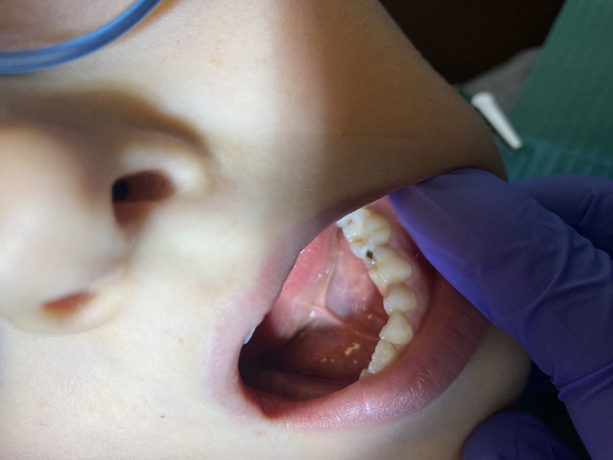 Dental V, MB