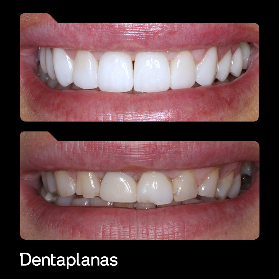 Dentaplanas