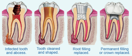 Dantų ir jų šaknų kanalų gydymas