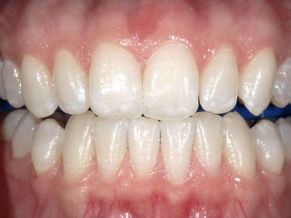 Profesionali burnos higiena Profesionali burnos higiena