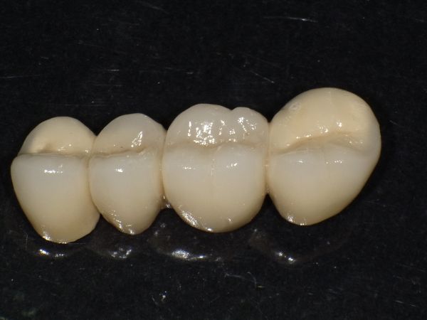 Dantų protezavimas Dantų protezavimas