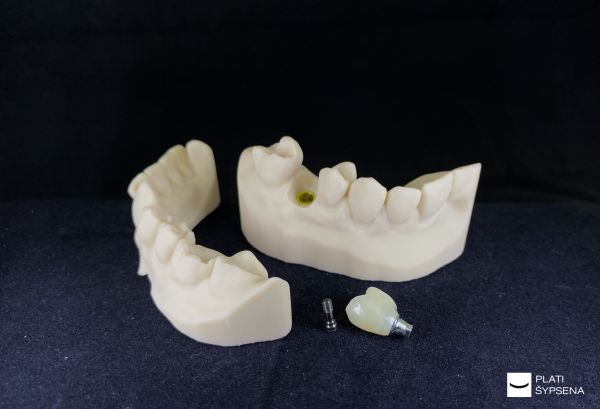 Cirkonio vainikėlis ant implanto kartu su 3D modeliu