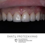 Dantų protezavimas