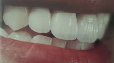 Dantų estetinis protezavimas