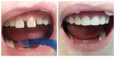 Dantų estetinis plombavimas