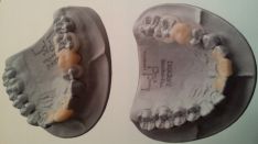 Išimami elastiniai laikini dantų protezai
