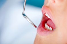Nuolatinių dantų padengimas silantais – apsaugine medžiaga su fluoru