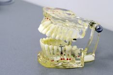 Dantų šaknų kanalų gydymas Dantų plombavimas