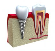 Implantacija