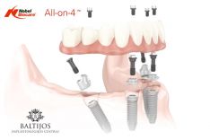 All-on-4 dantų implantai