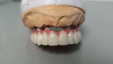 Dantų protezai(cirkonio keramikos) fiksuoti ,prisukami ant 6 implantų