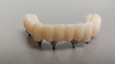 Dantų protezai  laikini plastmasiniai prisukami ant implantų