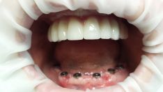 Dantų protezai (cirkonio keramikos)fiksuoti ,prisukami ant 6 implantų