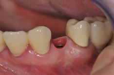 Dantų protezavimas ant implantų-kaip nuosavi dantys!