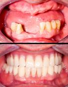 Viršutinio žandikaulio pilnas ir kelių apatinių dantų dalinis protezas savo išvaizda labai panašūs į nuosavus dantis ir dantenas