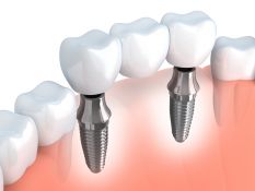 Dantų implantai – visam gyvenimui