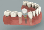 Dantų implantacija