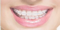 Ortodontija (dantų tiesinimas)