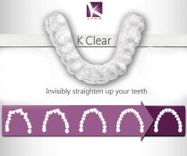 K Line Clear Aligner - skaidrios ortodontinės kapos