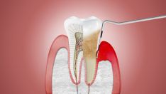 Periodontito gydymas