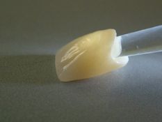 Dantų protezavimas (cirkonio keramikos vainikėlis)