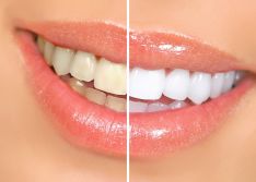 25% nuolaida burnos ertmės higienai ir dantų balinimui