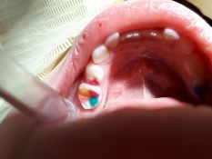 Vaikų dantų plombavimas spalvotomis plombomis