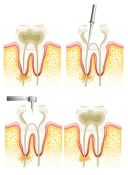 Endodontinis gydymas