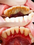 Burnos higiena, dantų implantų higiena