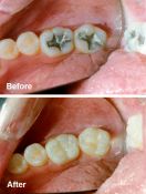 Dantų plombavimas, karieso gydymas