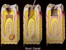 Endodontinis gydymas (šaknų kanalų )