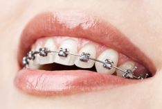 Ortodonto paslaugos