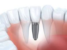 Dantų implantacija