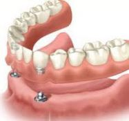 Dantų protezavimas, implantavimas