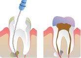 Endodontinis gydymas