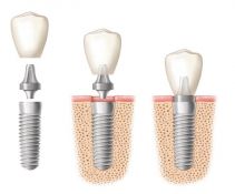 Dantų implantacija