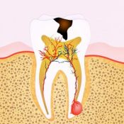 Endodontinis gydymas