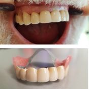 Išimami dantų protezai su užraktais