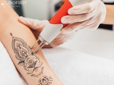 Tatuiruočių šalinimas lazeriu