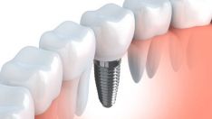 Dantų implantacija Straumann arba Megagen impantais
