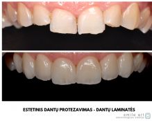 Dantų laminatės (estetinis dantų protezavimas)