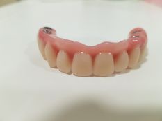 Dantų protezai (hibridiniai ,plastmasiniai dantys)bedančio žandikaulio fiksuoti,prisukami ant 4 arba 5 arba 6 implantų