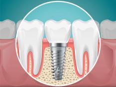Dantų implantai