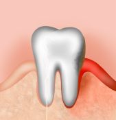 Periodontologinis gydymas