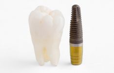 Straumann - šveicariškos kokybės implantai/ Dantų implantavimas