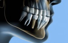 Dantų implantacija